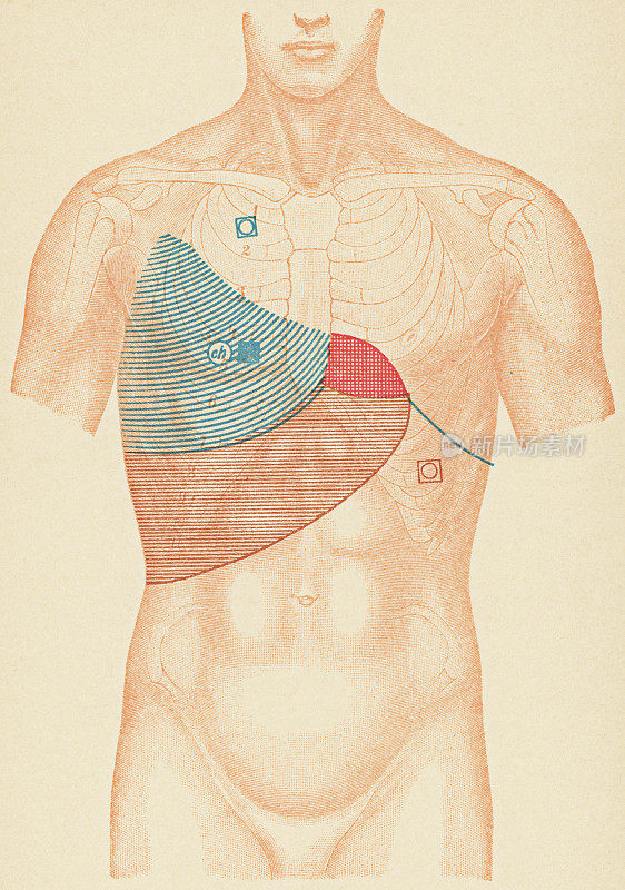 带听诊器和敲击点的人的躯干的医学说明从结核病胸腔积液的病人,正面视图- 19世纪